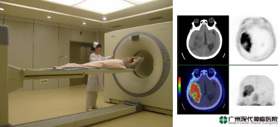 เทคโนโลยี PET/CT,การวินิจฉัย,โรคมะเร็ง,โรงพยาบาลมะเร็งสมัยใหม่กว่างโจว