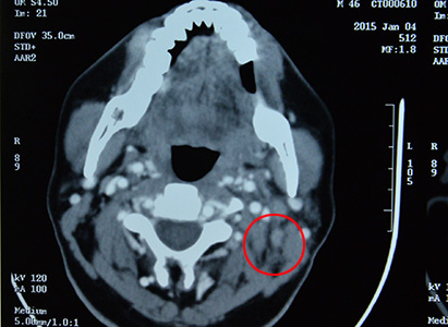 Nasopharyngeal Cancer, Interventional Therapy, Biological Immunotherapy, Chemotherapy, Modern Cancer Hospital Guangzhou 