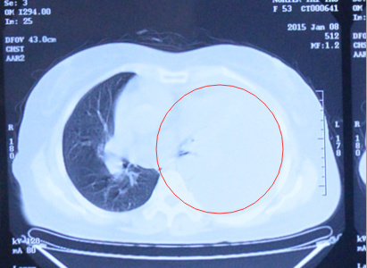 lung cancer, interventional therapy, chemotherapy, Modern Cancer Hospital Guangzhou