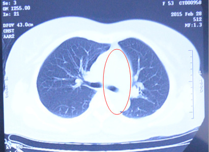 lung cancer, interventional therapy, chemotherapy, Modern Cancer Hospital Guangzhou