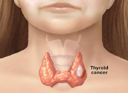 Thyroid cancer symptoms