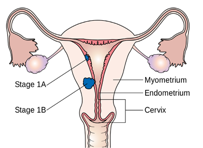 Vaginal Cancer Symptoms