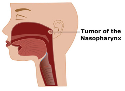 Nasopharyngeal Cancer, Nasopharyngeal Cancer Treatment, Nasopharyngeal Cancer Diagnosis, Nasopharyngeal Cancer Prevention, Nasopharyngeal Cancer Symptoms, Modern Cancer Hospital Guangzhou