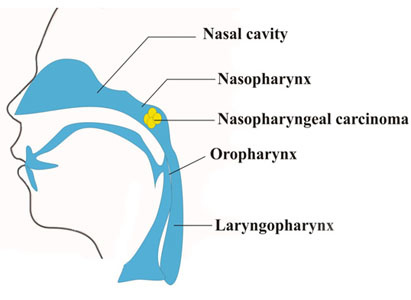 Nasopharyngeal Cancer, Nasopharyngeal Cancer Treatment, Modern Cancer Hospital Guangzhou