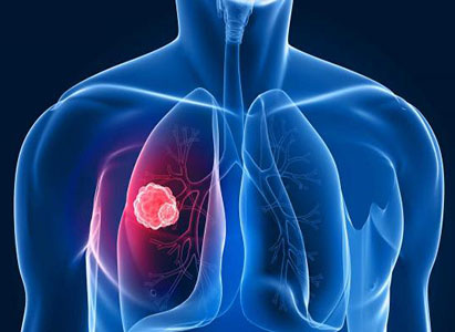 Lung cancer,Lung cancer causes,Lung cancer symptoms,Lung cancer treatment method