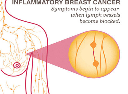 Breast cancer, breast cancer symptoms