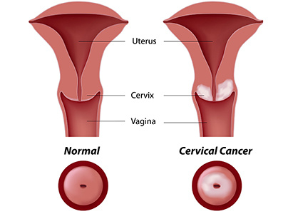 Cervical cancer,Symptoms of cervical cancer,Treatment methods of cervical cancer