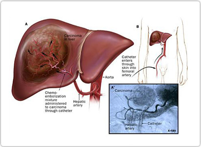 liver cancer, the diagnosis for liver cancer