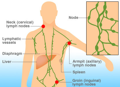 lymphoma, symptoms of lymphoma