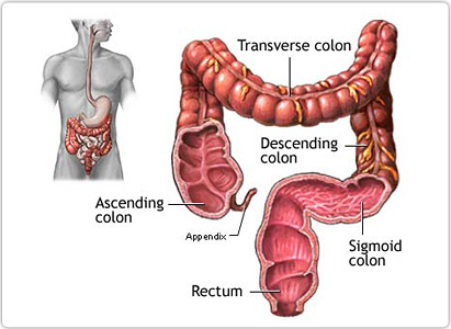 colon cancer, symptom of colon cancer