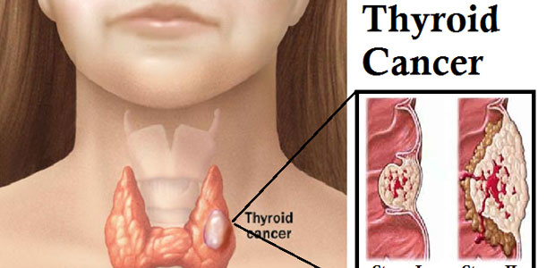 Thyroid cancer,Inspecting methods for thyroid cancer,Treatments for thyroid cancer