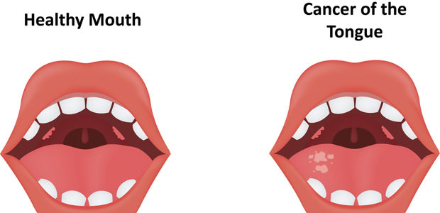 Tongue Cancer，tongue cancer symptoms