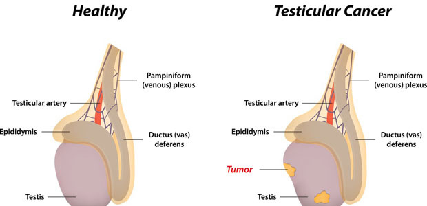 Testicular Cancer, testicular cancer symptoms, testicular cancer diagnosis, testicular cancer treatment