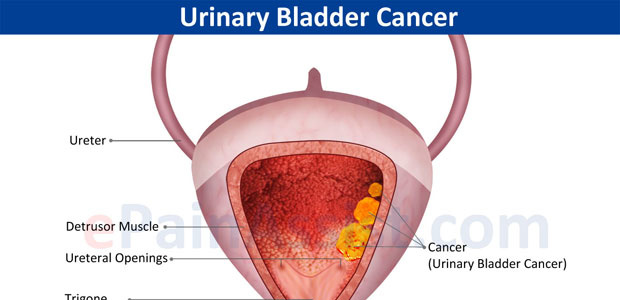 bladder cancer, bladder cancer symptoms, bladder cancer diagnosis, bladder cancer treatment