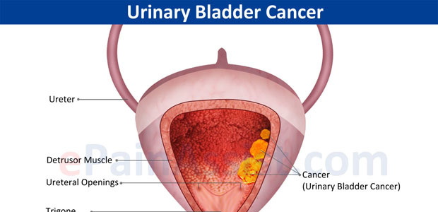 What is bladder cancer?