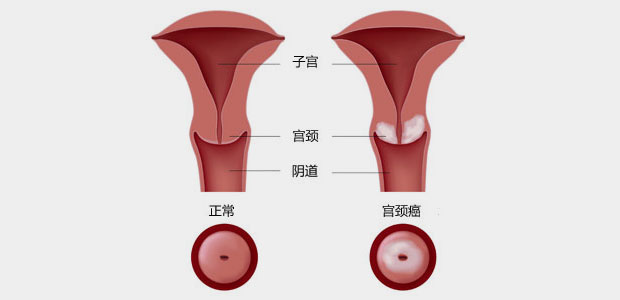 宫颈癌,宫颈癌症状,宫颈癌治疗