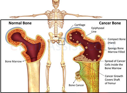 Jenis Kanker Tulang,Pengobatan Kanker Tulang , Terapi Minimal Invasif,St.Stamford Modern Cancer Hospital Guangzhou