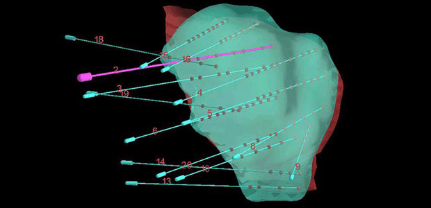 3D printing template assisted seed implantation, St. Stamford Modern Cancer Hospital Guangzhou, cancer, cancer treatment, minimally invasive breast cancer therapy, liver cancer, prostate cancer