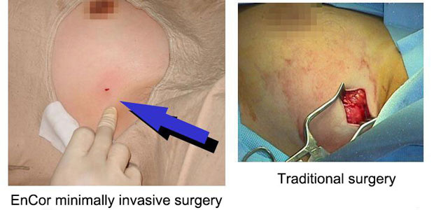 breast cancer, minimally invasive therapy, St. Stamford Modern Cancer Hospital Guangzhou, the Vacuum-assisted EnCor Minimally Invasive Surgery of Breast Lesion breast cancer, minimally invasive therapy, St. Stamford Modern Cancer Hospital Guangzhou, the Vacuum-assisted EnCor Minimally Invasive Surgery of Breast Lesion