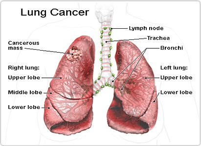 มะเร็งปอด,อาการมะเร็งปอด,โรงพยาบาลมะเร็งสมัยใหม่กว่างโจว