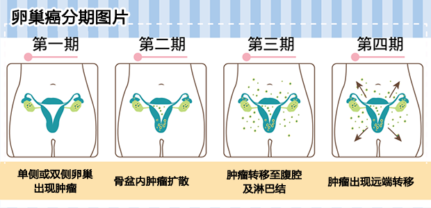 卵巢癌分期 圣丹福广州现代肿瘤医院