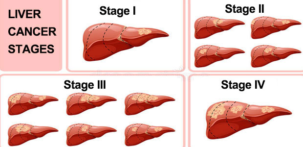 Liver Cancer Staging St. Stamford Modern Cancer Hospital