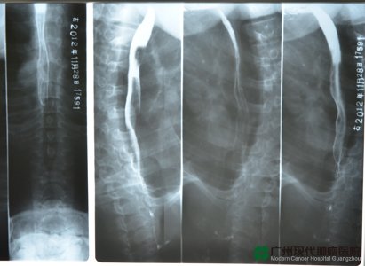 esophageal cancer, Modern Cancer Hospital Guangzhou