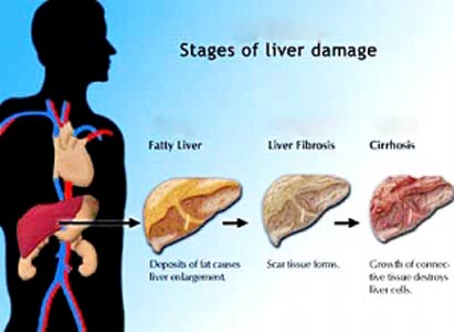 Why Are Men More Prone to Developing Liver Cancer?