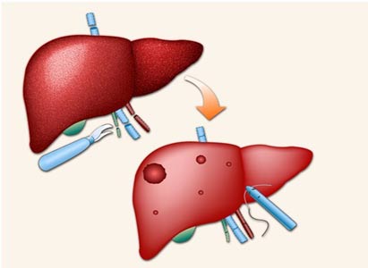 Japan Get Important Clues by Analyzing Liver Cancer with the Help of Super Computer 