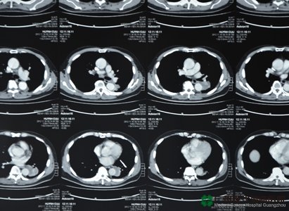 Lung Cancer, Lung cancer treatment