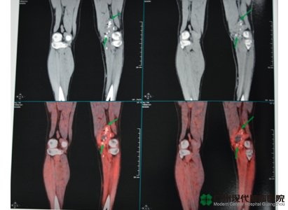 เนื้องอกในกล้ามเนื้อแข้ง