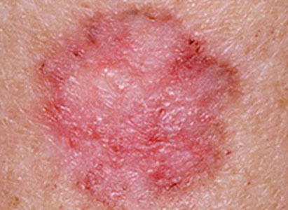 kanker kulit, Pencegahan kanker kulit, Gejala kanker kulit