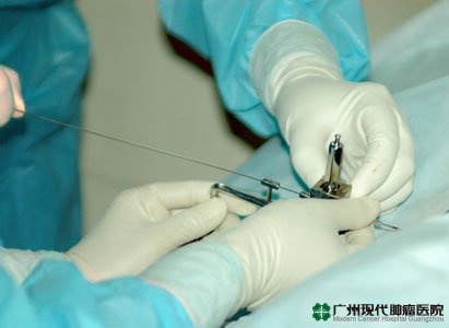 การรักษาด้วยการฝังแร่