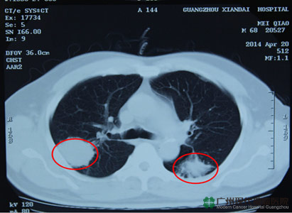 ung thư phổi, điều trị ung thư phổi