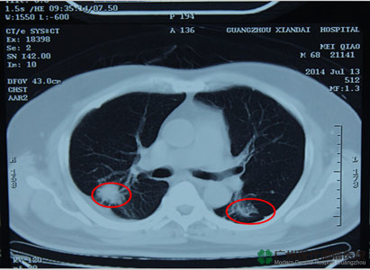 ung thư phổi, điều trị ung thư phổi