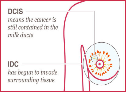 invasive ductal carcinoma (IDC), breast cancer treatment, Modern Cancer Hospital Guangzhou