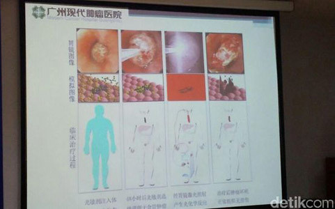 St. Stamford Modern Cancer Hospital Guangzhou, kanker laring, pengobatan kanker laring, metode Photodynamic