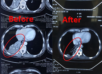 lung cancer, lung cancer treatment, interventional therapy, cryotherapy, natural therapy, St. Stamford Modern Cancer Hospital Guangzhou