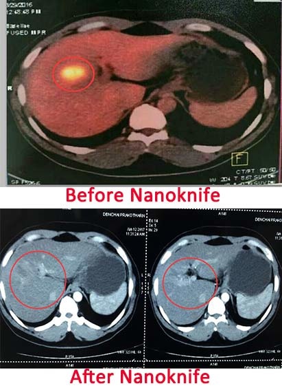 Colorectal Cancer, Colorectal Cancer Treatment, Colorectal Cancer with Liver Metastases, Nanoknife, St. Stamford Modern Cancer Hospital Guangzhou (MCHG)